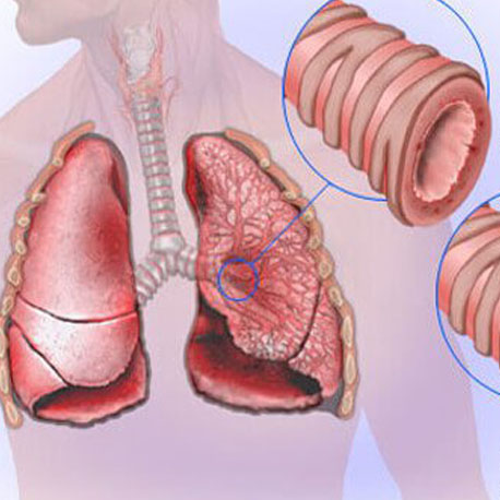 About Bronchitis - We Cure Bronchitis By Naturopathy Treatment