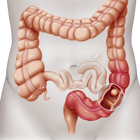 About Colitis - We Cure Colitis By Naturopathy Treatment
